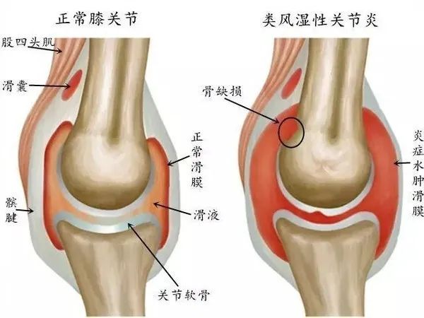 中醫(yī)定向透藥治療儀對(duì)關(guān)節(jié)炎的治療.jpg